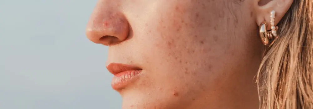 Gua sha et acné : est-ce compatible ? Précautions et conseils - Zelia Paris