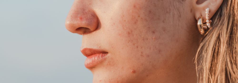 Gua sha et acné : est-ce compatible ? Précautions et conseils